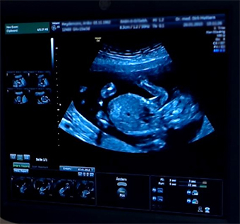 Ultraschallfoto von unserem Baby